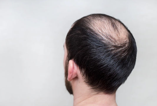 Understanding Male Pattern Baldness: Causes, Stages and Treatment